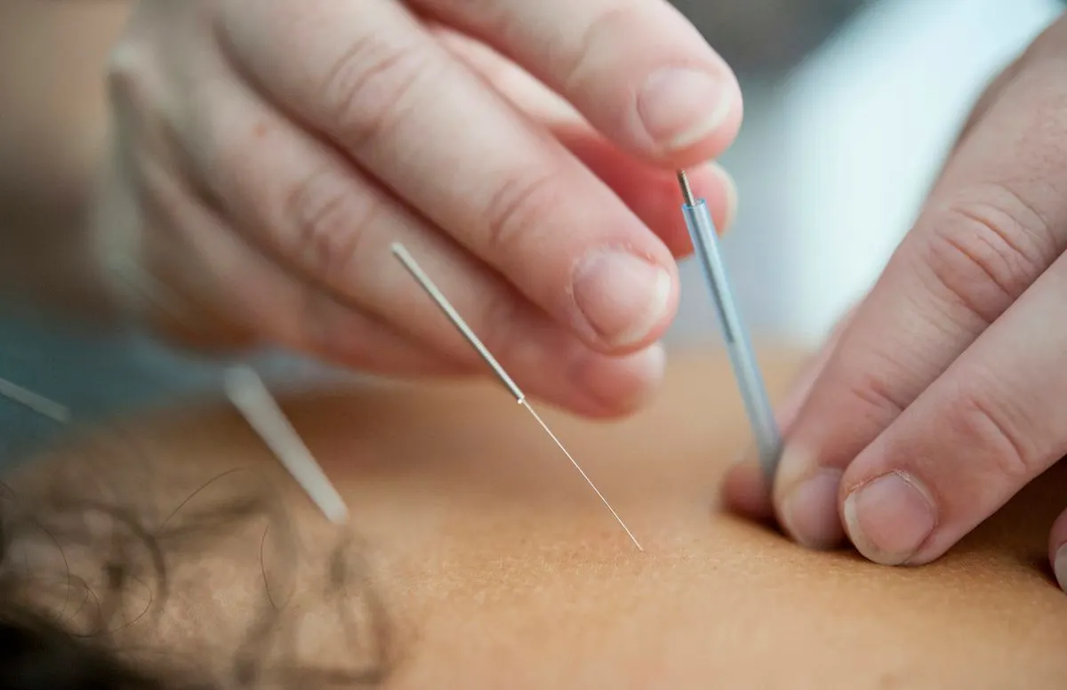 A practitioner gently placing a fine acupuncture needle
