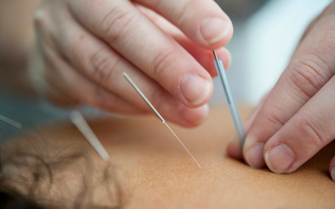 What Happens During a Home-Visit Acupuncture Appointment?